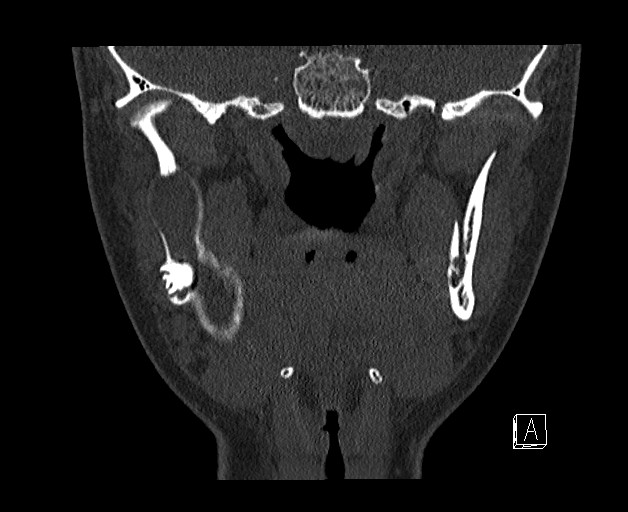File:Ameloblastoma (Radiopaedia 26645-26793 bone window 18).jpg