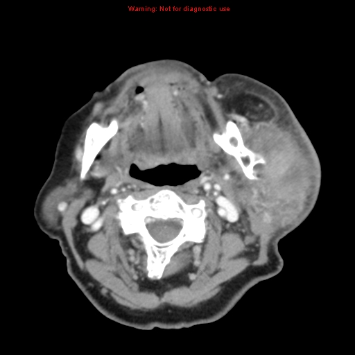 File:Ameloblastoma (Radiopaedia 27437-27631 A 43).jpg