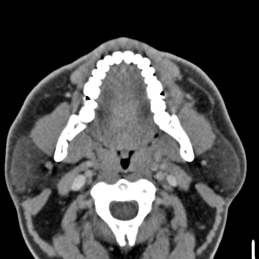 File:Ameloblastoma (Radiopaedia 33677-34806 Axial non-contrast 18).png