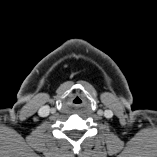 File:Ameloblastoma (Radiopaedia 33677-34806 Axial non-contrast 37).png
