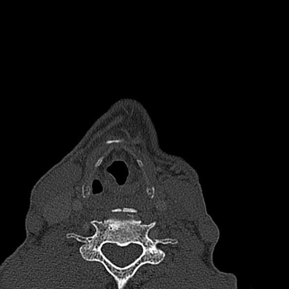 Ameloblastoma (Radiopaedia 51921-57766 Axial bone window 1).jpg