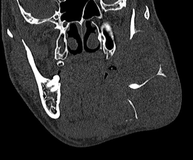 Ameloblastoma (Radiopaedia 51921-57766 Coronal bone window 115).jpg