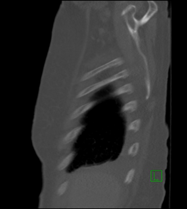 Amiodarone deposition in the liver (Radiopaedia 77587-89780 Sagittal bone window 85).jpg