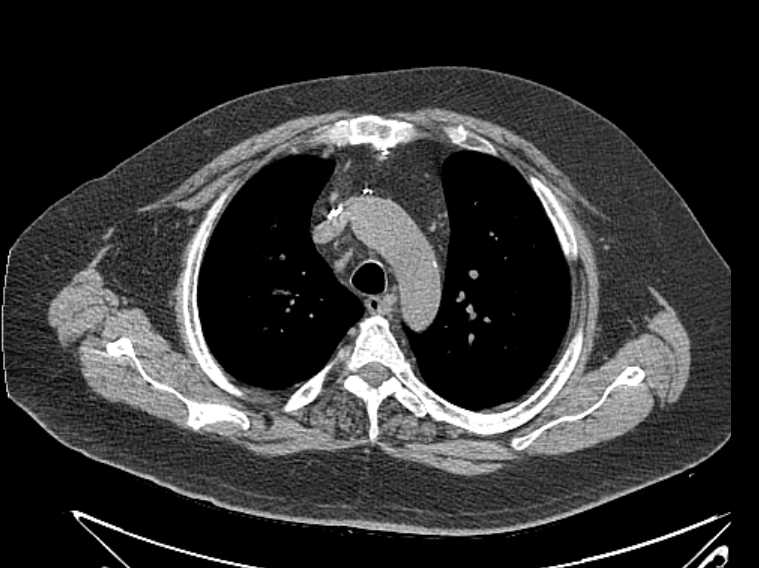 Amiodarone lung (Radiopaedia 62514-70769 Axial non-contrast 25).jpg