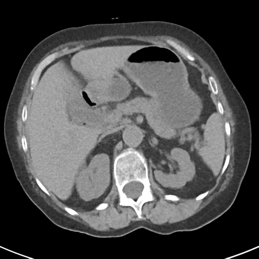 File:Ampullary adenocarcinoma (Radiopaedia 34013-35237 Axial non-contrast 16).png