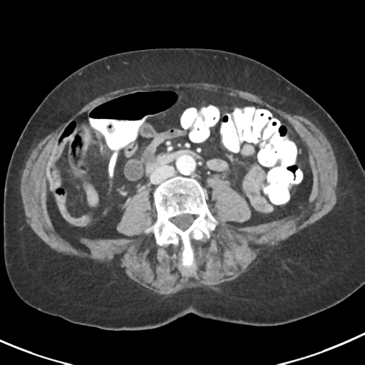 Ampullary adenocarcinoma (Radiopaedia 34013-35237 C 29).png