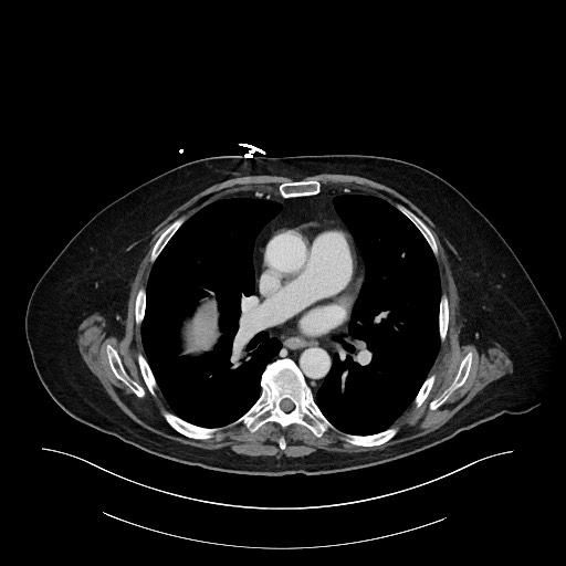 Ampullary adenocarcinoma (Radiopaedia 59373-66734 C 4).jpg