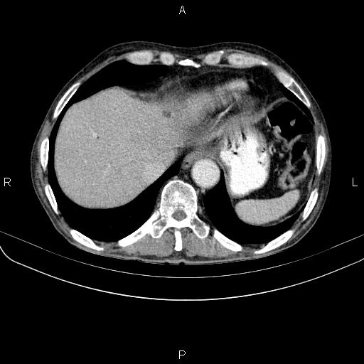File:Ampullary adenocarcinoma (Radiopaedia 86093-102033 B 48).jpg