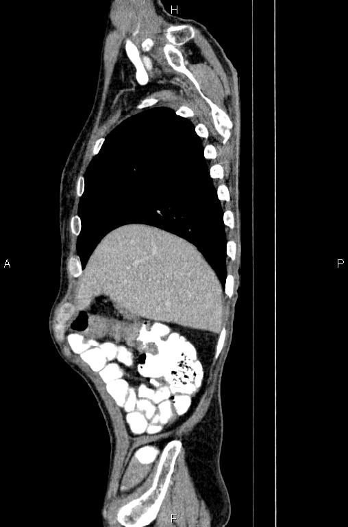 Ampullary adenocarcinoma (Radiopaedia 86093-102033 E 14).jpg