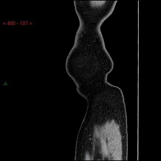 Ampullary carcinoma (Radiopaedia 56396-63056 D 106).jpg