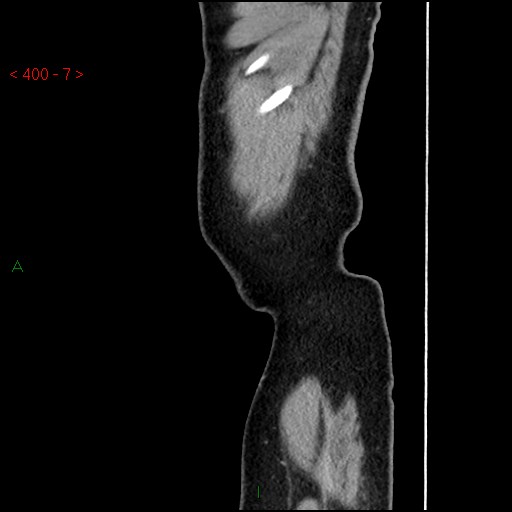 Ampullary carcinoma (Radiopaedia 56396-63056 D 6).jpg