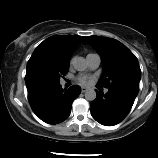 Amyloidosis - bronchial and diffuse nodular pulmonary involvement (Radiopaedia 60156-67744 Axial non-contrast 29).jpg