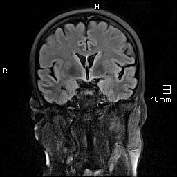 File:Amyotrophic lateral sclerosis (Radiopaedia 70821-81017 Coronal FLAIR 13).jpg