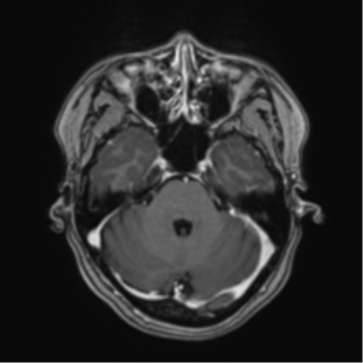 Anaplastic astroblastoma (Radiopaedia 55666-62194 Axial T1 C+ 21).png