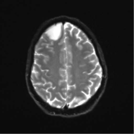 Anaplastic astrocytoma IDH mutant (Radiopaedia 50046-55341 Axial DWI 21).png