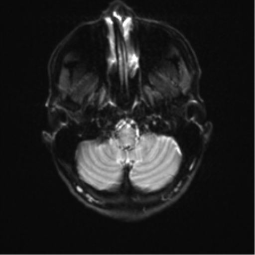File:Anaplastic astrocytoma IDH mutant (Radiopaedia 50046-55341 Axial DWI 4).png