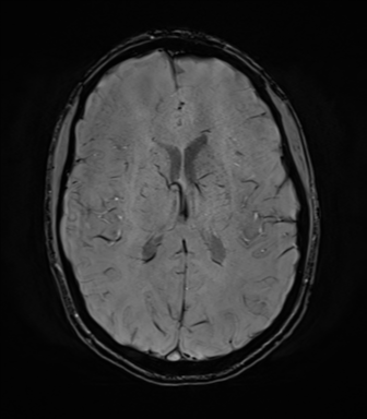 File:Anaplastic astrocytoma IDH mutant (Radiopaedia 50046-55341 Axial SWI 52).png