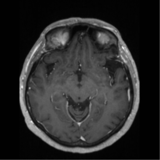 File:Anaplastic astrocytoma IDH wild-type (pseudoprogression) (Radiopaedia 42209-45276 Axial T1 C+ 67).png