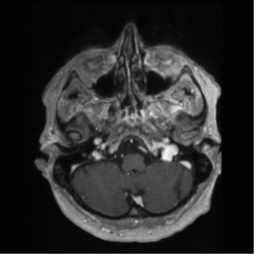 File:Anaplastic astrocytoma IDH wild-type (pseudoprogression) (Radiopaedia 42209-45277 Axial T1 C+ 18).png