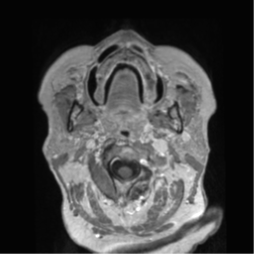 Anaplastic astrocytoma IDH wild-type (pseudoprogression) (Radiopaedia 42209-45278 Axial T1 C+ 3).png