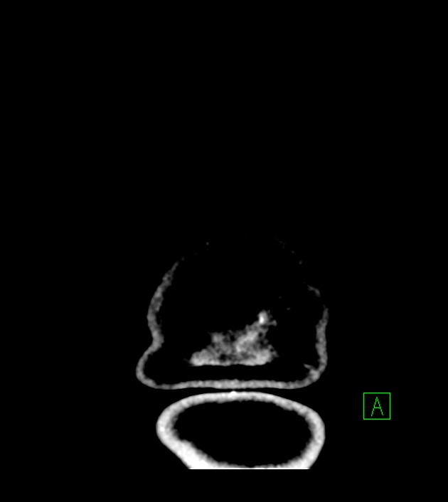 Anaplastic oligodendroglioma (Radiopaedia 79571-92753 Coronal non-contrast 73).jpg