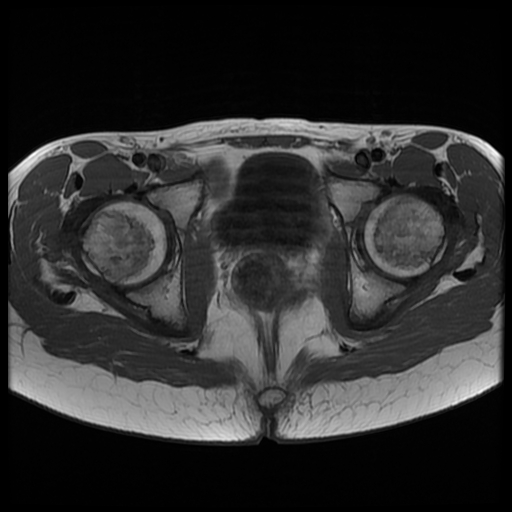 File:Androgen insensitivity syndrome (Radiopaedia 38585-40727 Axial T1 19).jpg