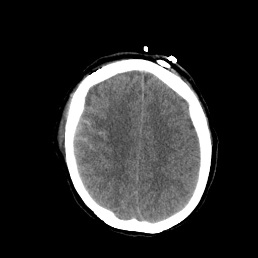 Aneursym related subarachnoid hemorrhage with hydrocephalus (Radiopaedia 45105-49085 Axial non-contrast 37).jpg