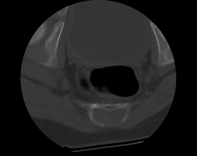 Aneurysmal bone cyst - sacrum (Radiopaedia 65190-74195 Axial bone window 41).jpg