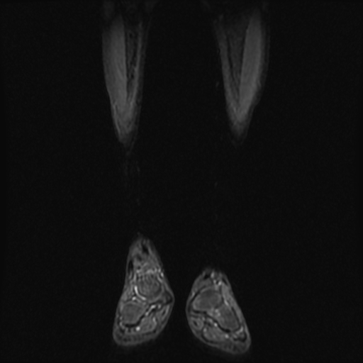 File:Aneurysmal bone cyst - tibia (Radiopaedia 22343-22367 Coronal STIR 3).jpg