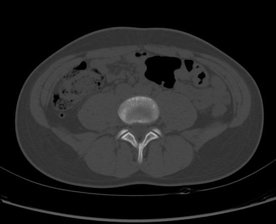 File:Aneurysmal bone cyst of ischium (Radiopaedia 25957-26094 Axial bone window 5).png