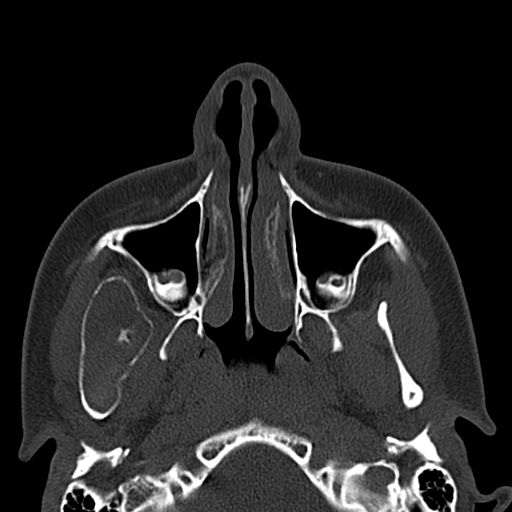 Aneurysmal bone cyst of the mandible (Radiopaedia 43280-46601 Axial bone window 64).jpg
