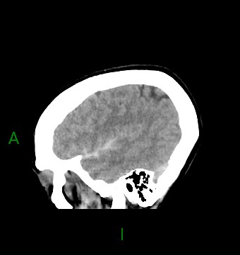 File:Aneurysmal subarachnoid hemorrhage with intra-axial extension (Radiopaedia 84371-99699 B 39).jpg