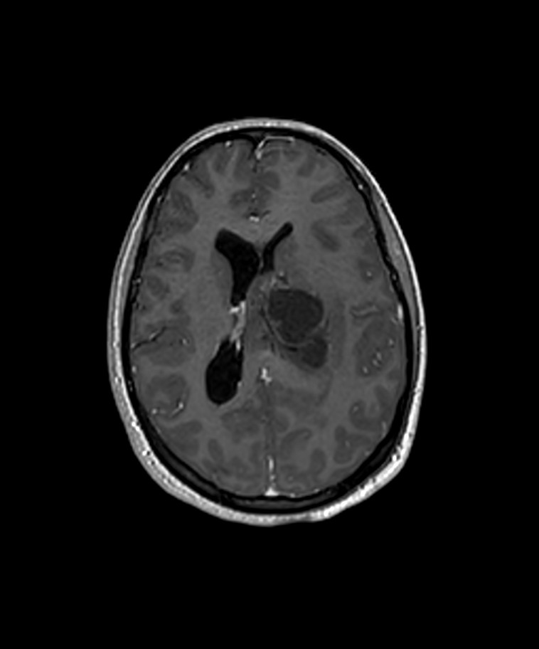 Angiomatous meningioma (Radiopaedia 79459-92577 Axial T1 C+ 3D ISO 13).jpg