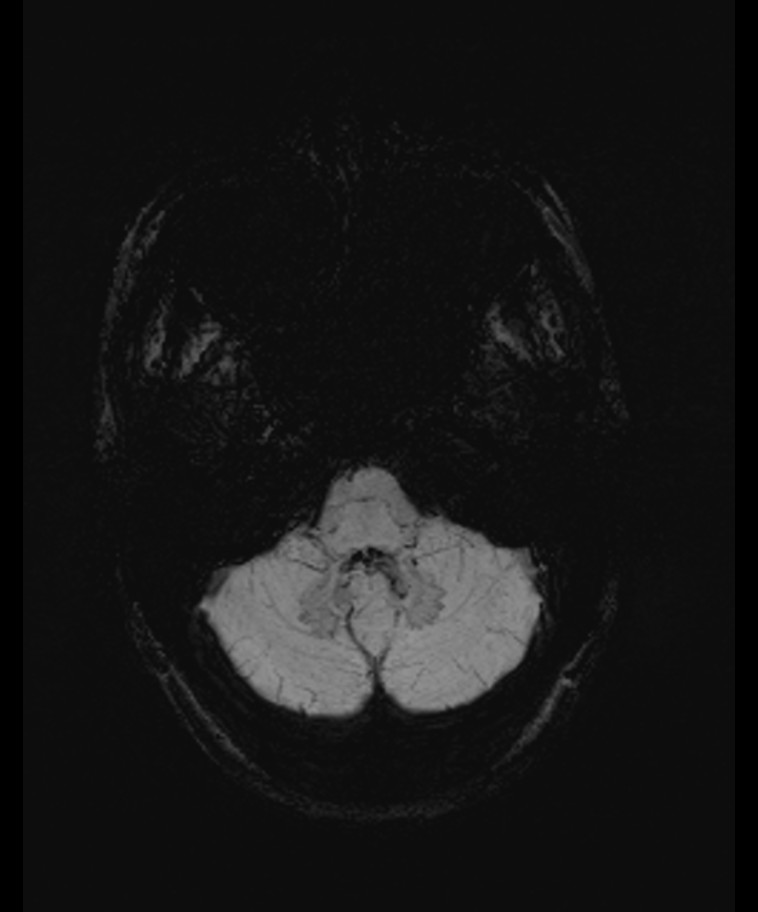 Angiomatous meningioma (Radiopaedia 79459-92579 E 9).jpg