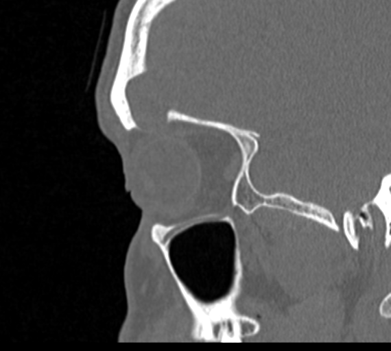 Angular epidermoid cyst (Radiopaedia 46908-51439 Sagittal bone window 74).png