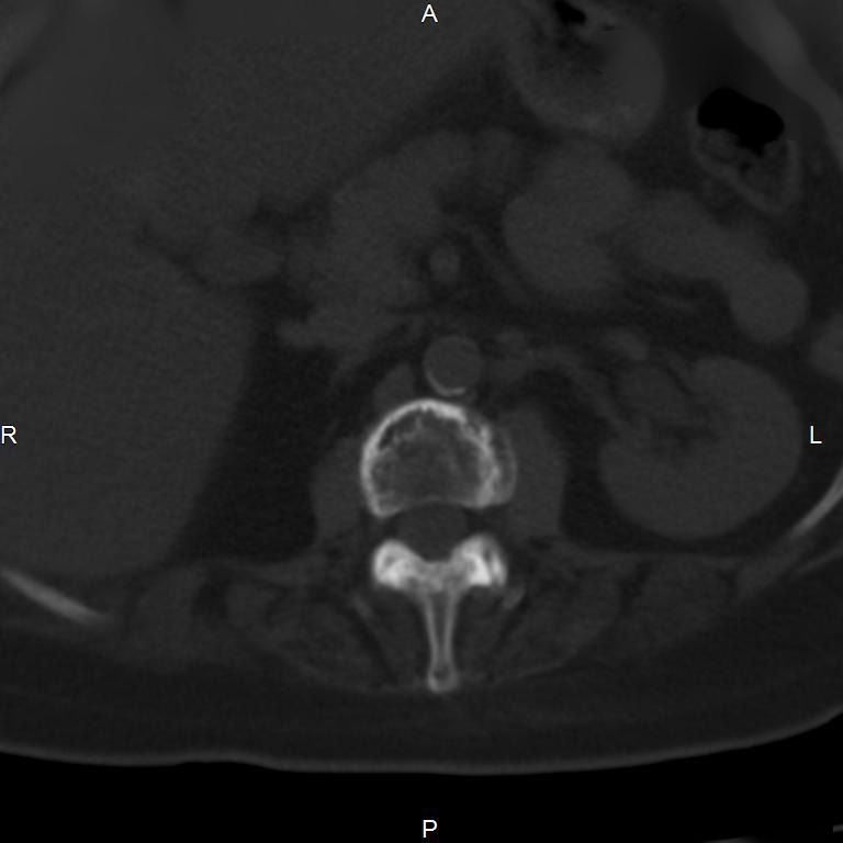 Ankylosing spondylitis (Radiopaedia 8748-9556 Axial bone window 23).jpg