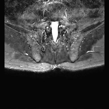 File:Ankylosing spondylitis with zygapophyseal arthritis (Radiopaedia 38433-40517 D 14).jpg