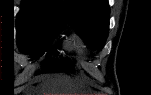 Anomalous left coronary artery from the pulmonary artery (ALCAPA) (Radiopaedia 70148-80181 B 38).jpg