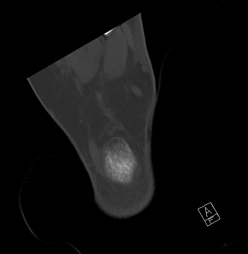 File:Anterior calcaneal process fracture (Radiopaedia 63353-71943 Axial bone window 122).jpg