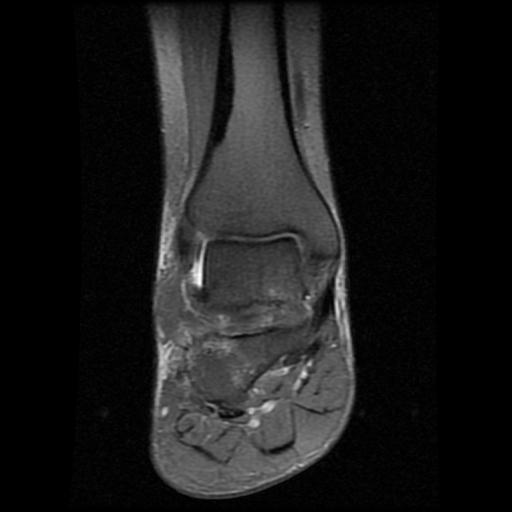 File:Anterior calcaneal process fracture (Radiopaedia 71377-81705 Coronal PD fat sat 7).jpg