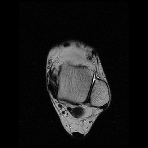 File:Anterior calcaneal process fracture (Radiopaedia 74654-85611 Axial T2 8).jpg