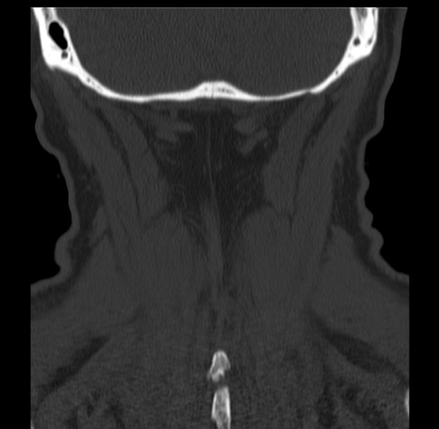 Anterior cervical postdiscectomy arthrodesis (Radiopaedia 32678-33646 Coronal bone window 65).jpg