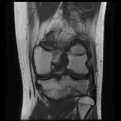 File:Anterior cruciate ligament tear (Radiopaedia 61500-69462 Coronal T1 14).jpg