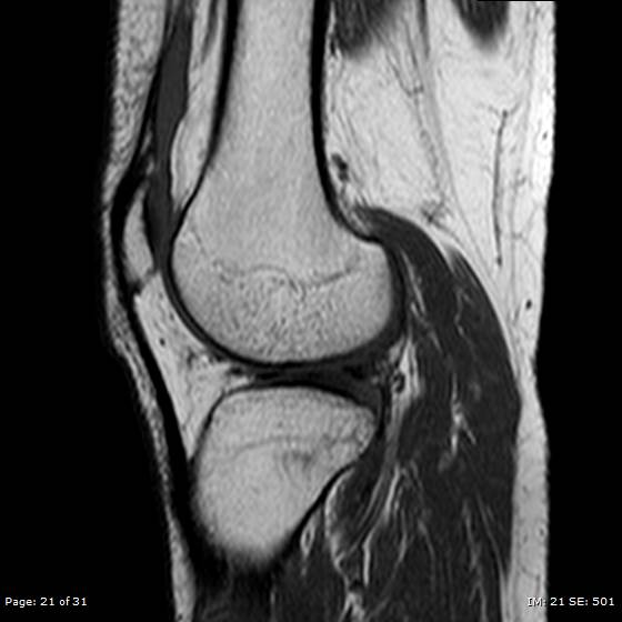 File:Anterior cruciate ligament tear (Radiopaedia 70783-80964 Sagittal T1 21).jpg