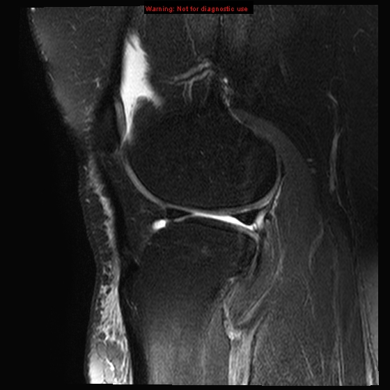 File:Anterior cruciate ligament tear - complete (Radiopaedia 12175-12514 Sagittal T2 fat sat 6).jpg