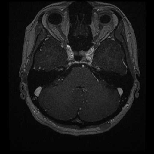 Anterior inferior cerebellar artery vascular loop - type II (Radiopaedia 70991-81209 Axial T1 C+ 41).jpg