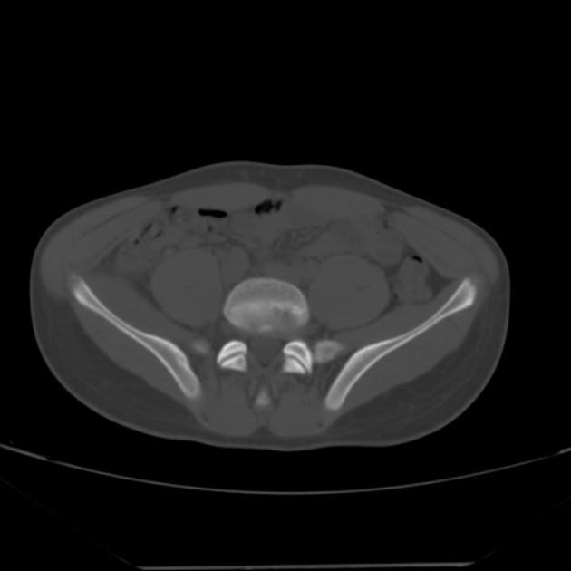 Anterior inferior iliac spine avulsion fracture (Radiopaedia 49469-54627 Axial bone window 3).jpg