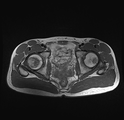 File:Anterior inferior iliac spine avulsion fracture (Radiopaedia 81312-95000 Axial T1 16).jpg
