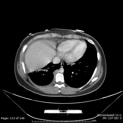 File:Anterior mediastinal B cell Lymphoma (Radiopaedia 50677-56114 A 57).jpg