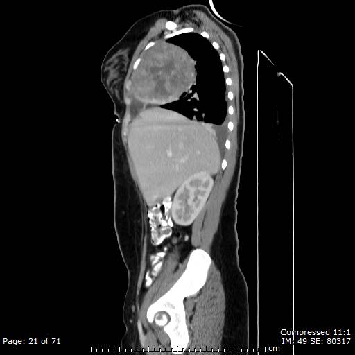 File:Anterior mediastinal B cell Lymphoma (Radiopaedia 50677-56114 C 11).jpg